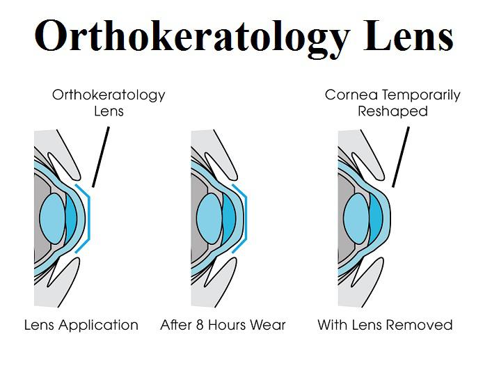 Orthokeratology